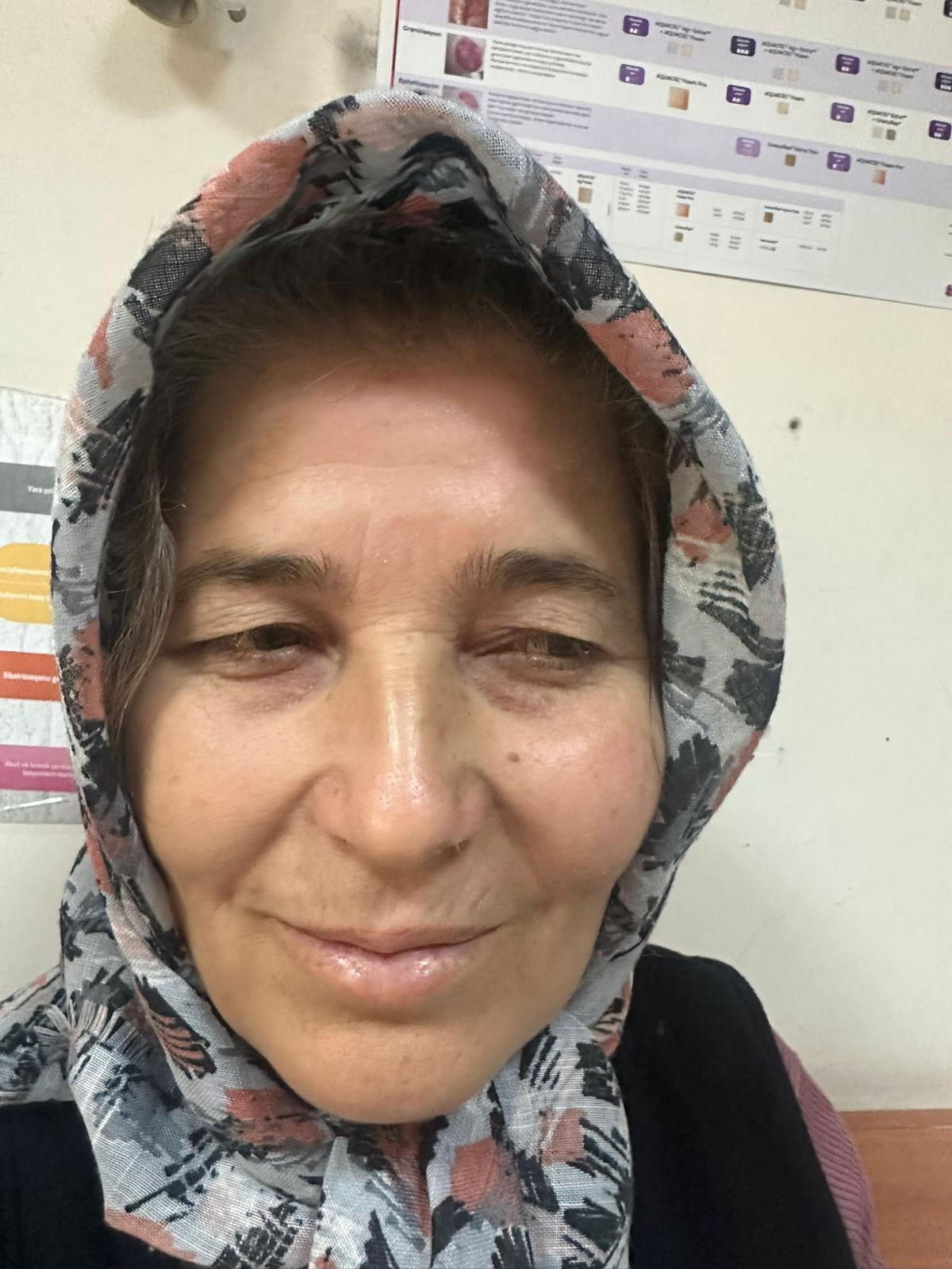 yanık